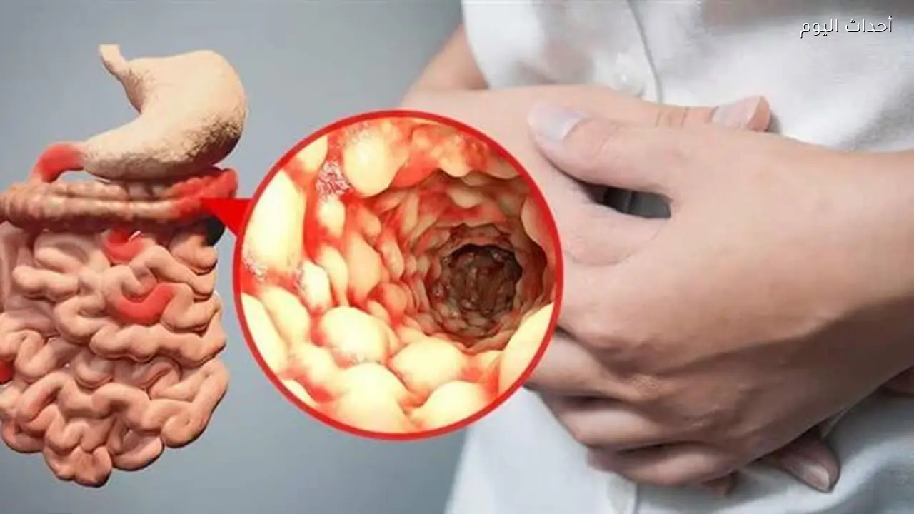علماء يحددون سببًا وراثيًا لبعض حالات أمراض الأمعاء الالتهابية