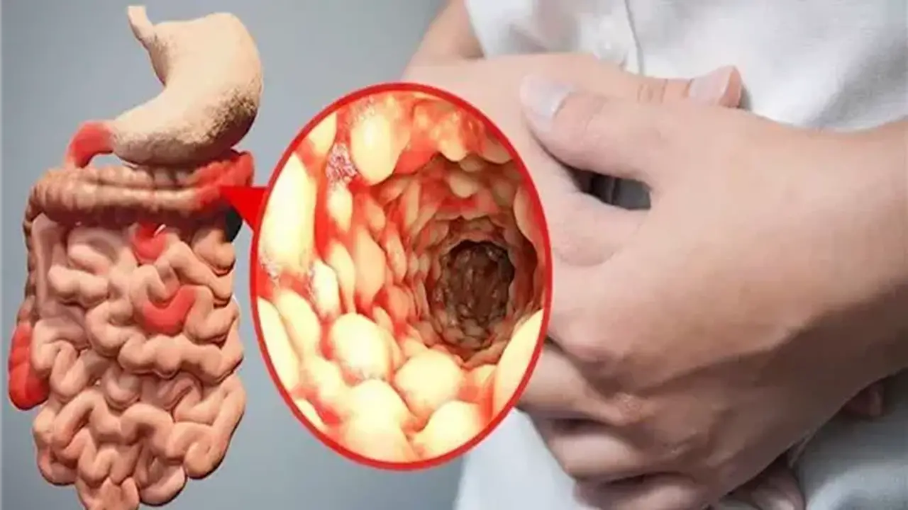 دراسة تكشف عن غذاء مفاجئ يُساعد في تهدئة التهاب الأمعاء