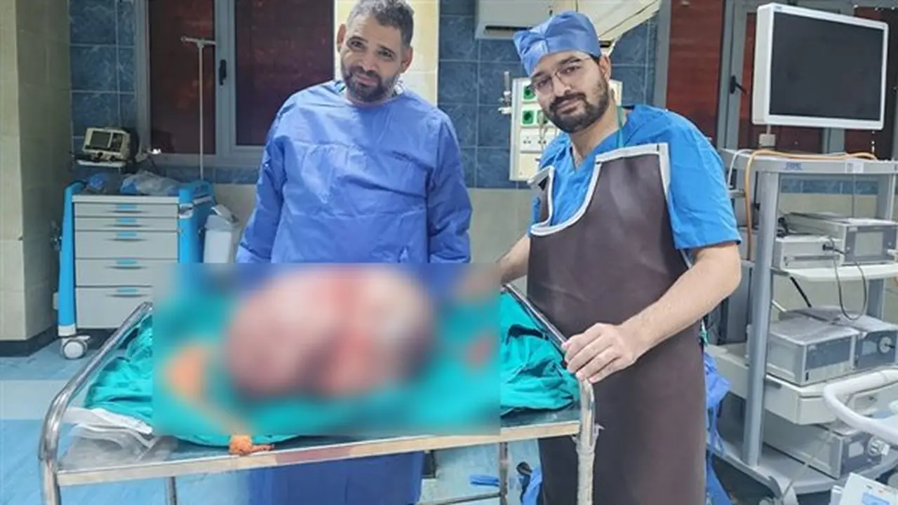 فريق طبي بجامعة المنيا ينجح في استئصال ورم يزن 24 كيلو جرامًا من مبيض سيدة