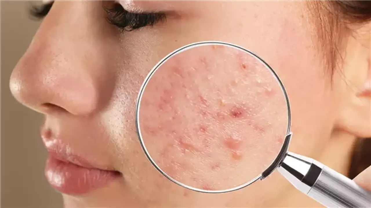 هل تساعد مكملات الزنك في علاج حب الشباب؟