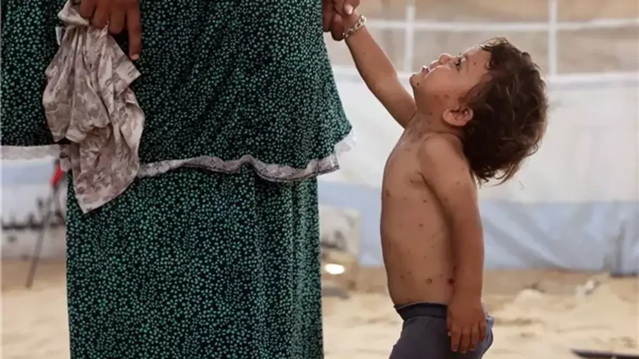 الأمم المتحدة تحذر من انتشار سريع لمرض جدري الماء في غزة