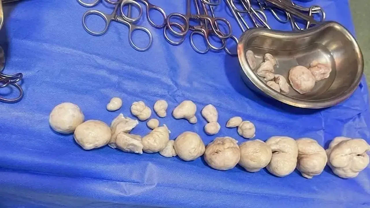 نجاح استئصال 21 ورمًا ليفيًا من رحم سيدة في كفر الشيخ بعد معاناة طويلة