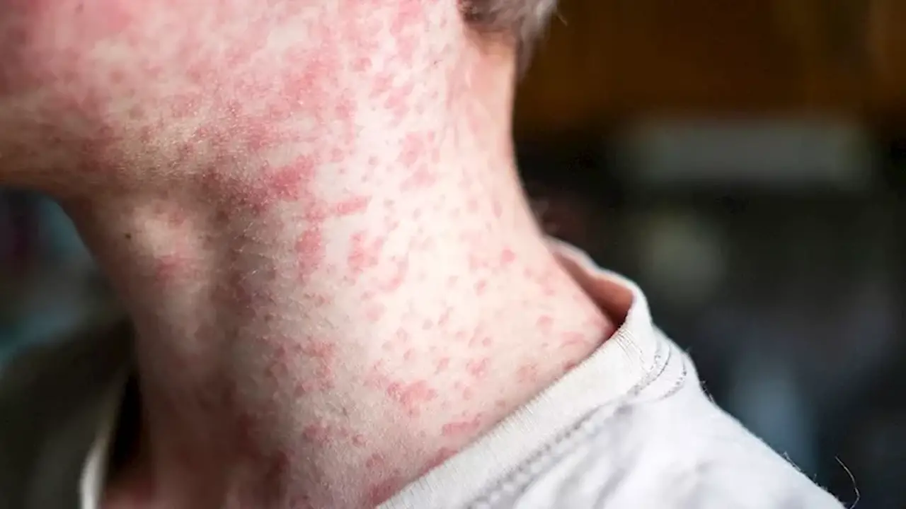 أمريكا تسجل أعلى معدل إصابات بالحصبة منذ 35 عاماً