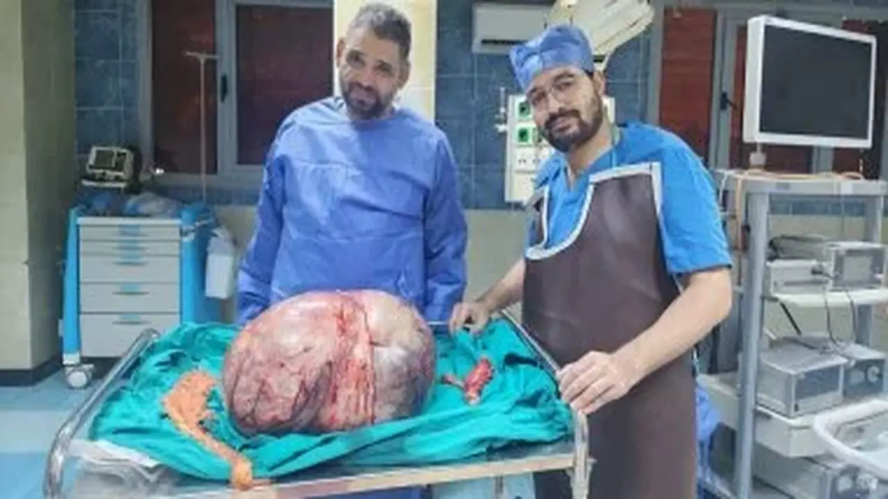 نجاح استئصال ورم مبيضي نادر بوزن 24 كيلوجرامًا في مستشفى المنيا الجامعي