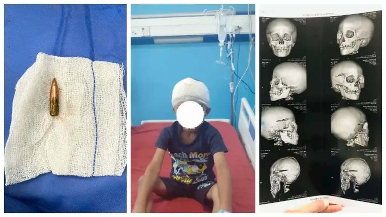 نجاح جراحة استخراج رصاصة من مخ طفل في سوهاج